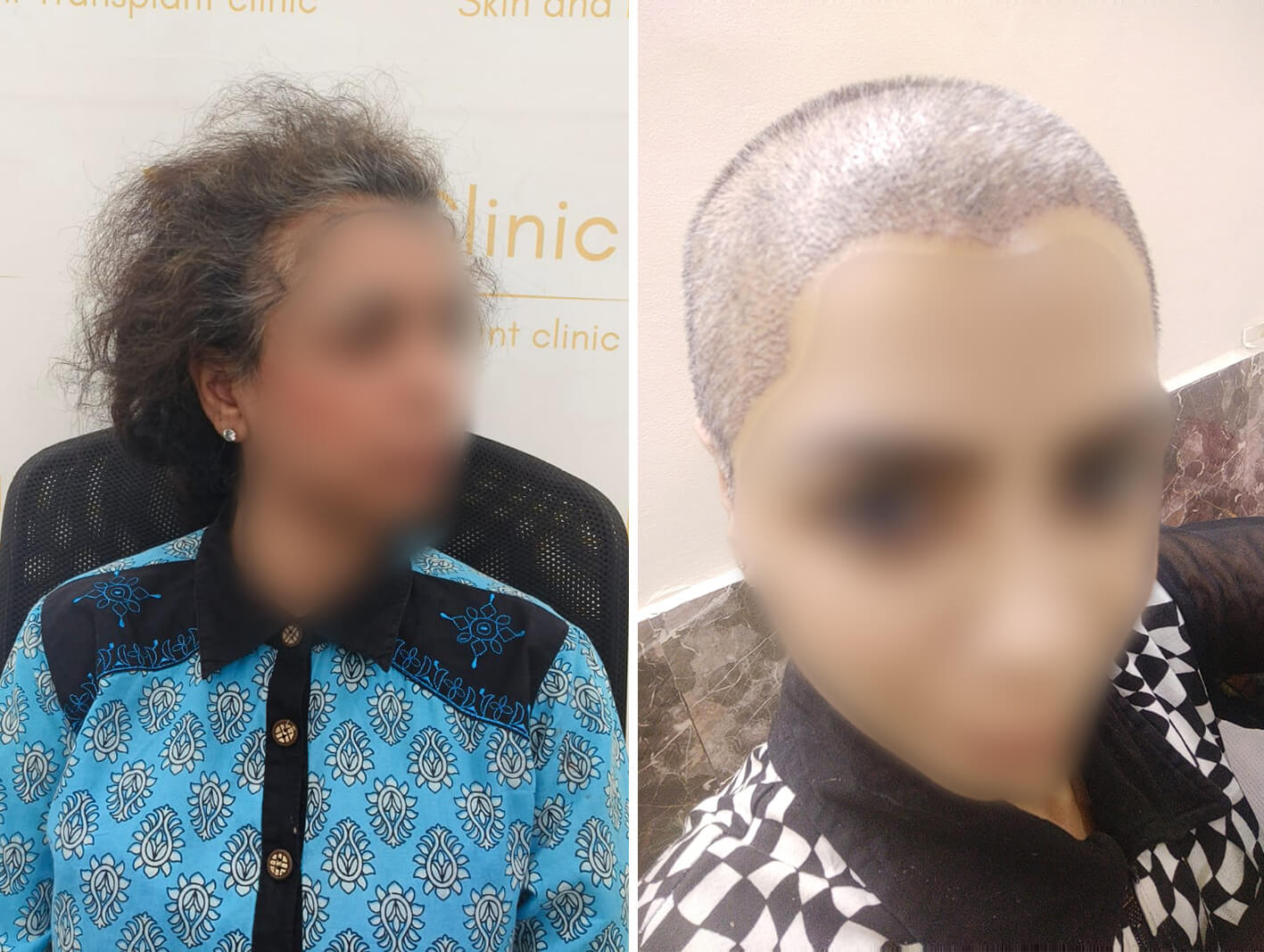 Female hair transplant before after